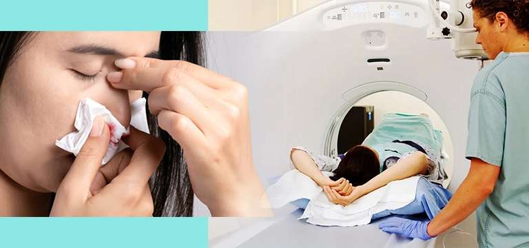 MRI in Nosebleed - Causes and Diagnosing Procedure